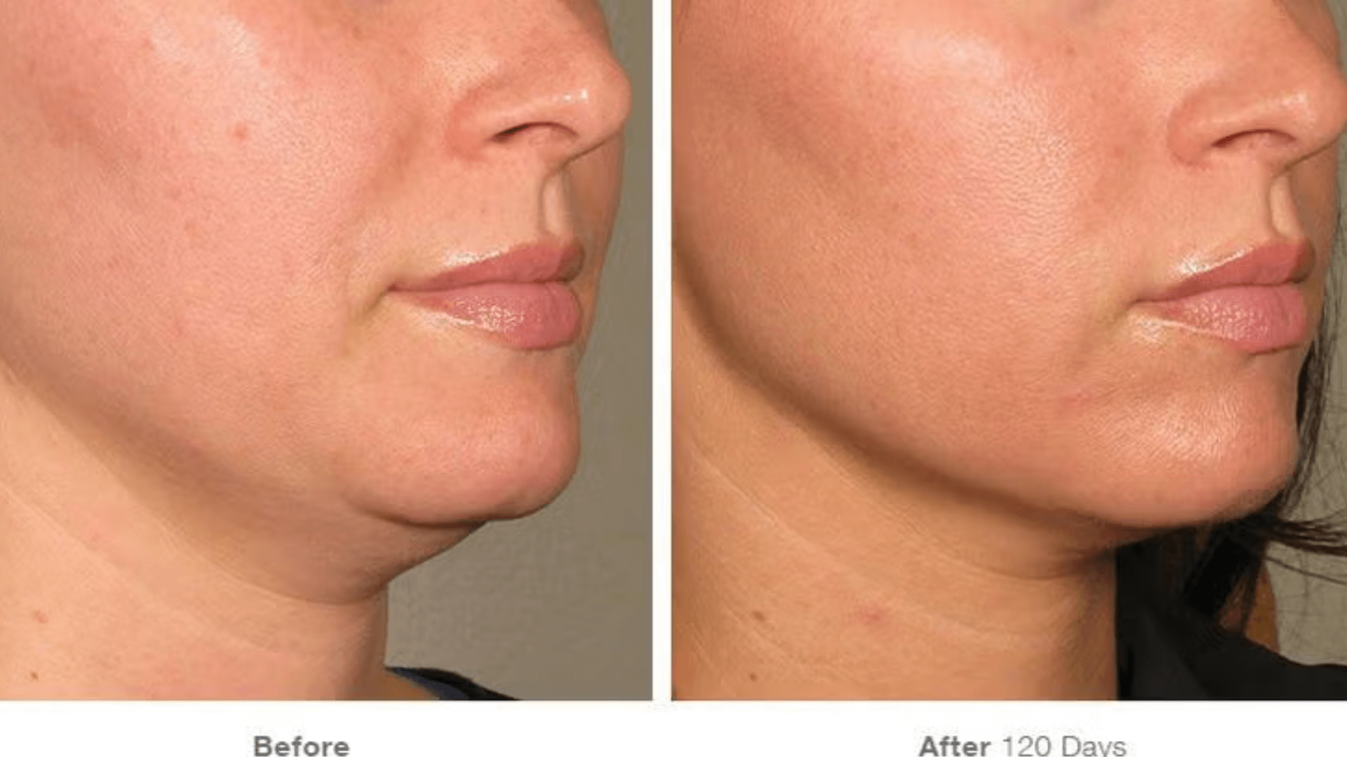 Before and After chin