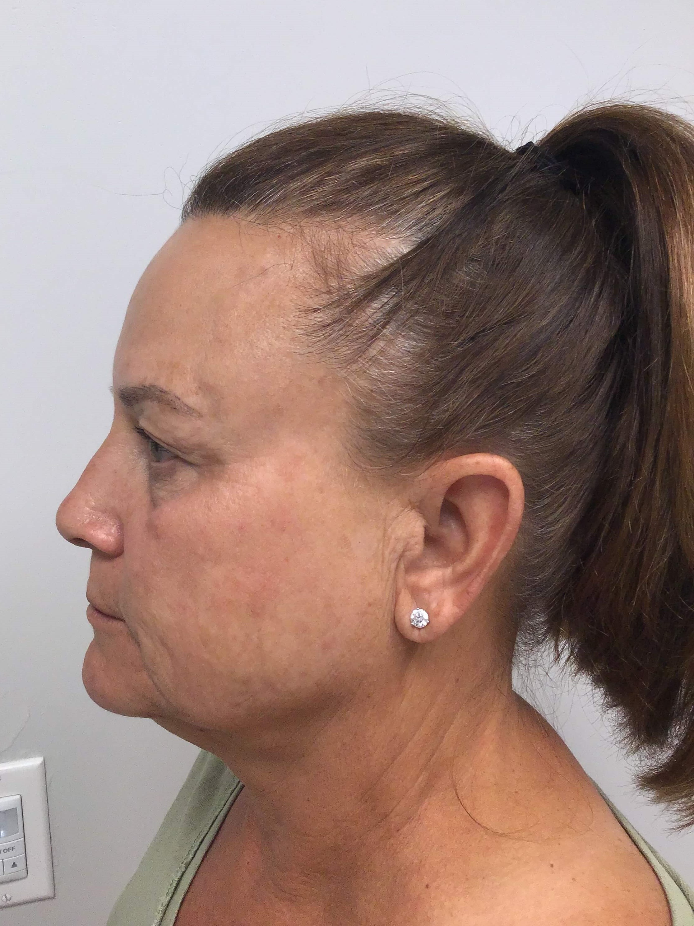Small Bbl After ONE Treatment of BBL