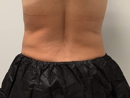 1 session of Coolsculpting Elite to Flanks
